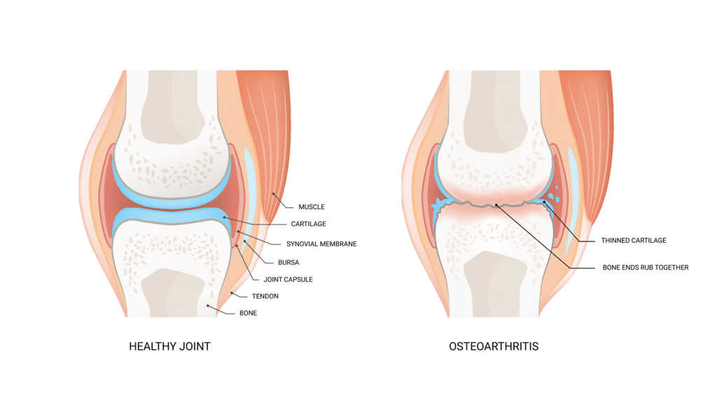 Diagram: A healthy knee joint with intact cartilage compared to osteoarthritis with thinned cartilage and bone ends rubbing against each other